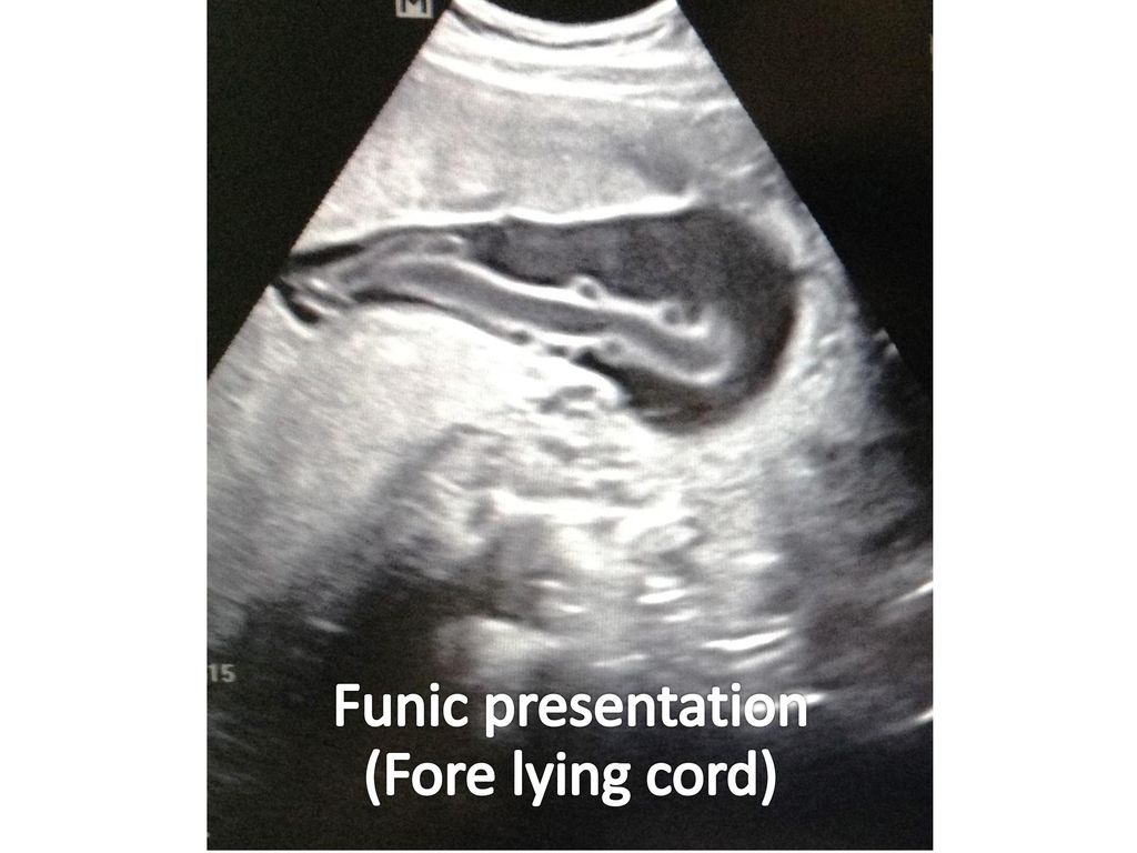 Prolapsed cord Funic presentation (Fore lying cord)