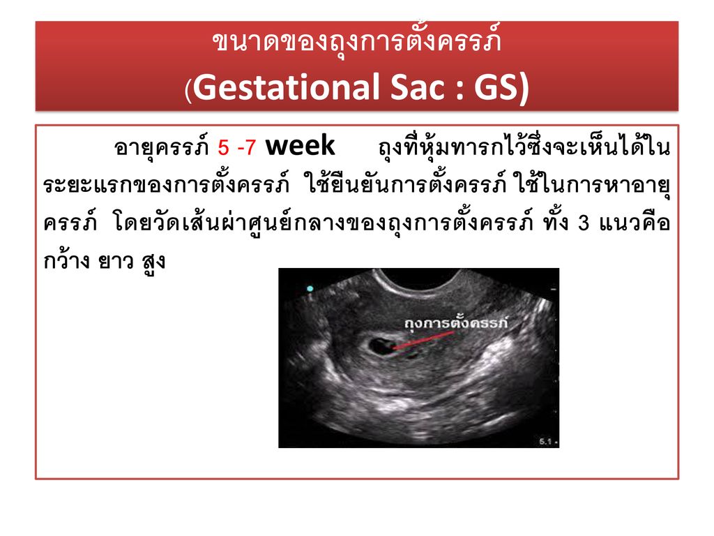 ขนาดของถุงการตั้งครรภ์ (Gestational Sac : GS)