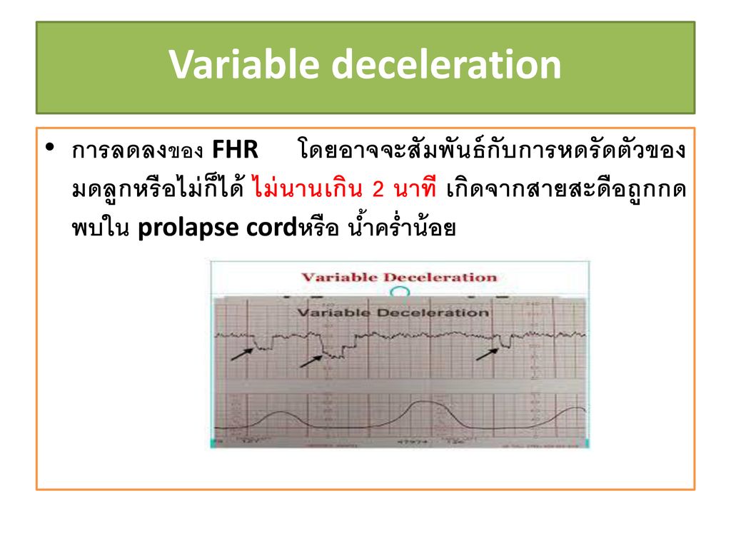 Variable deceleration