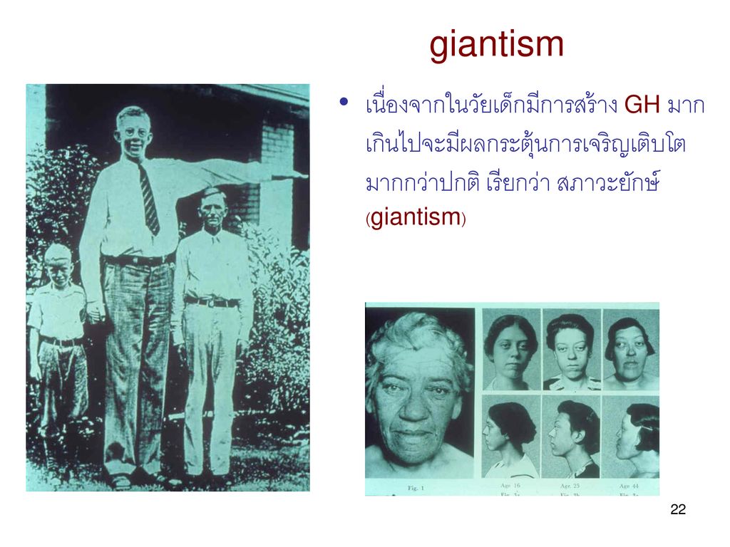 giantism เนื่องจากในวัยเด็กมีการสร้าง GH มากเกินไปจะมีผลกระตุ้นการเจริญเติบโตมากกว่าปกติ เรียกว่า สภาวะยักษ์(giantism)
