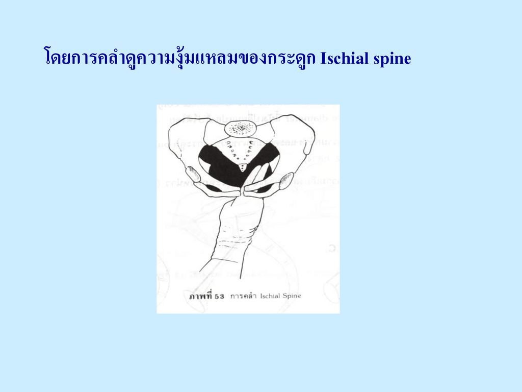 โดยการคลำดูความงุ้มแหลมของกระดูก Ischial spine