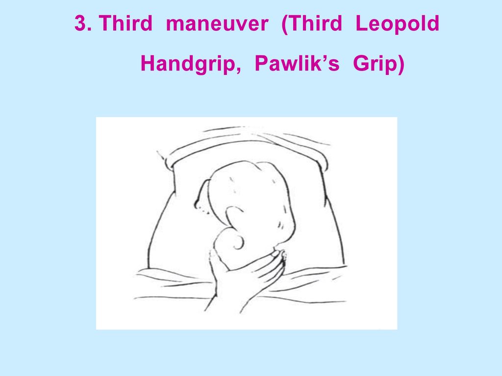 3. Third maneuver (Third Leopold Handgrip, Pawlik’s Grip)