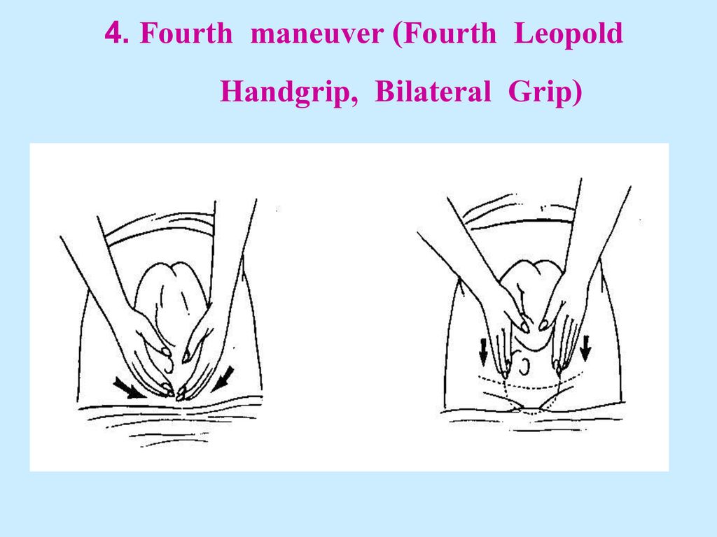 4. Fourth maneuver (Fourth Leopold Handgrip, Bilateral Grip)