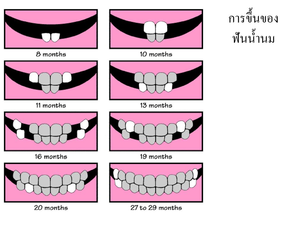 โรคฟันผุในเด็กปฐมวัย Ppt ดาวน์โหลด