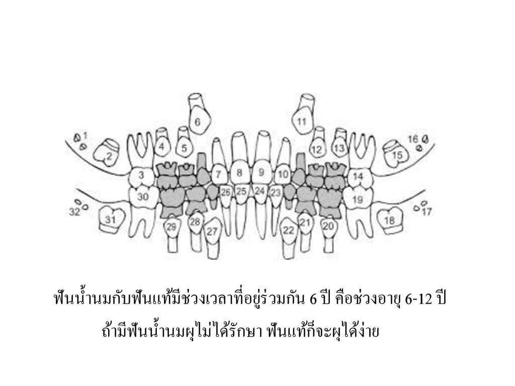 โรคฟันผุในเด็กปฐมวัย Ppt ดาวน์โหลด