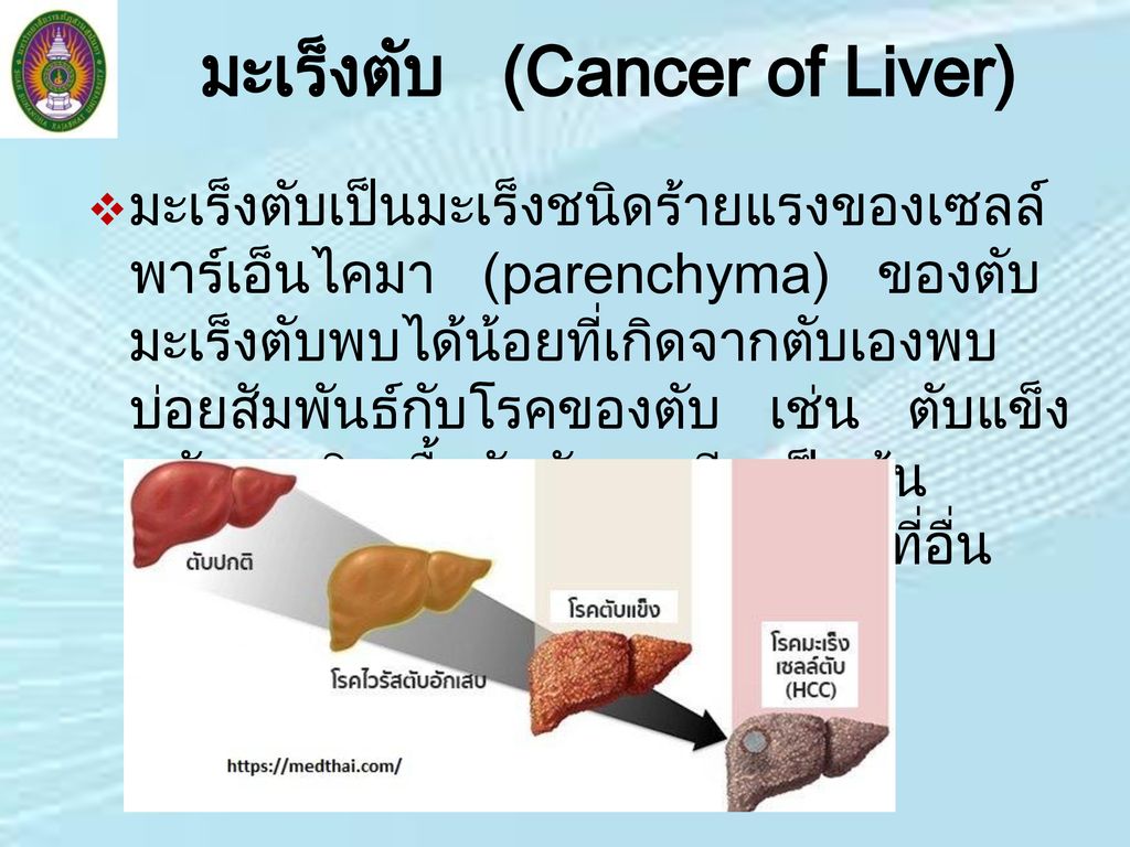 มะเร็งตับ (Cancer of Liver)