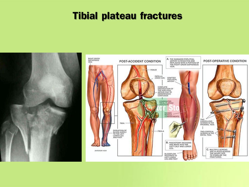 Tibial plateau fractures
