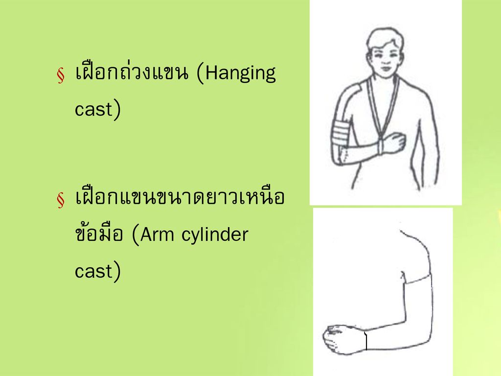 เฝือกถ่วงแขน (Hanging cast)