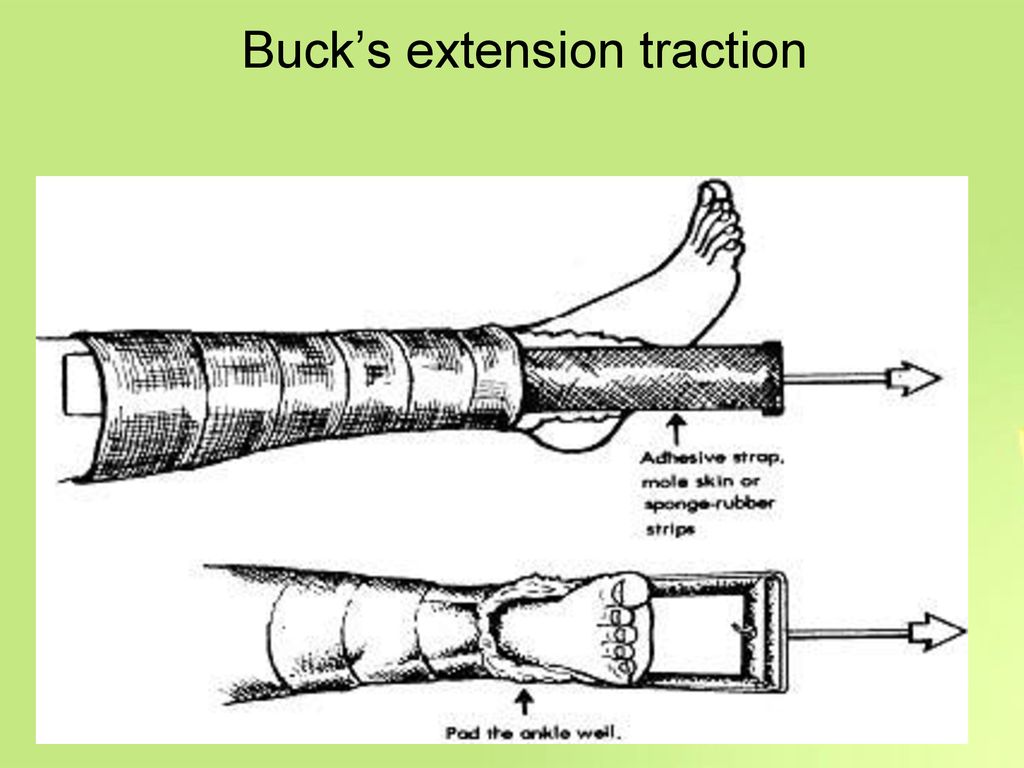 Buck’s extension traction
