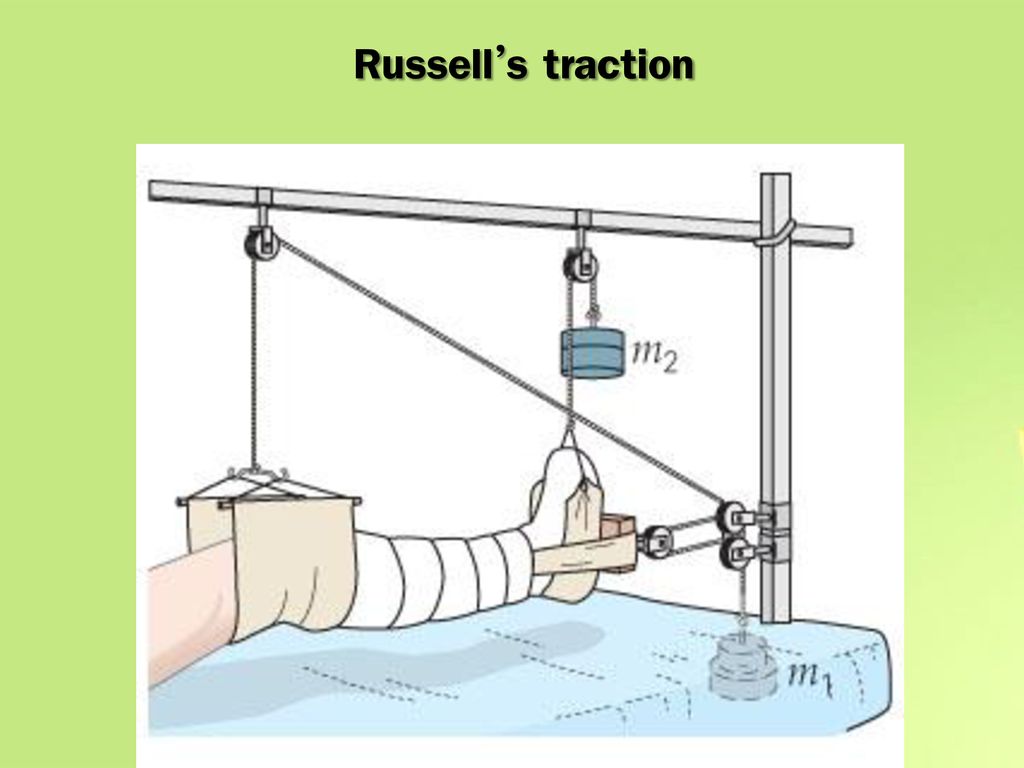 Russell’s traction
