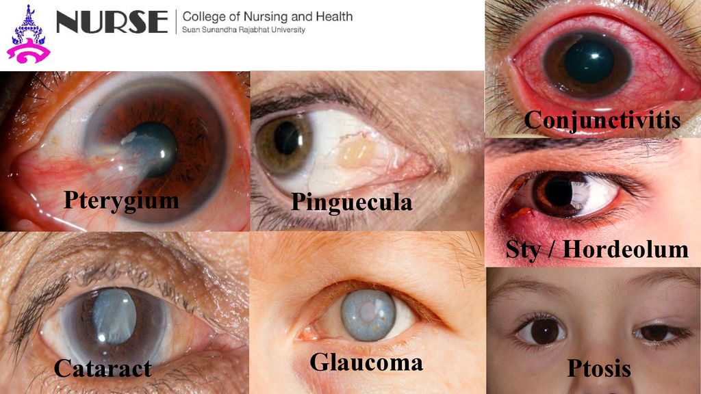 Conjunctivitis Pterygium Pinguecula Sty / Hordeolum Glaucoma Cataract Ptosis