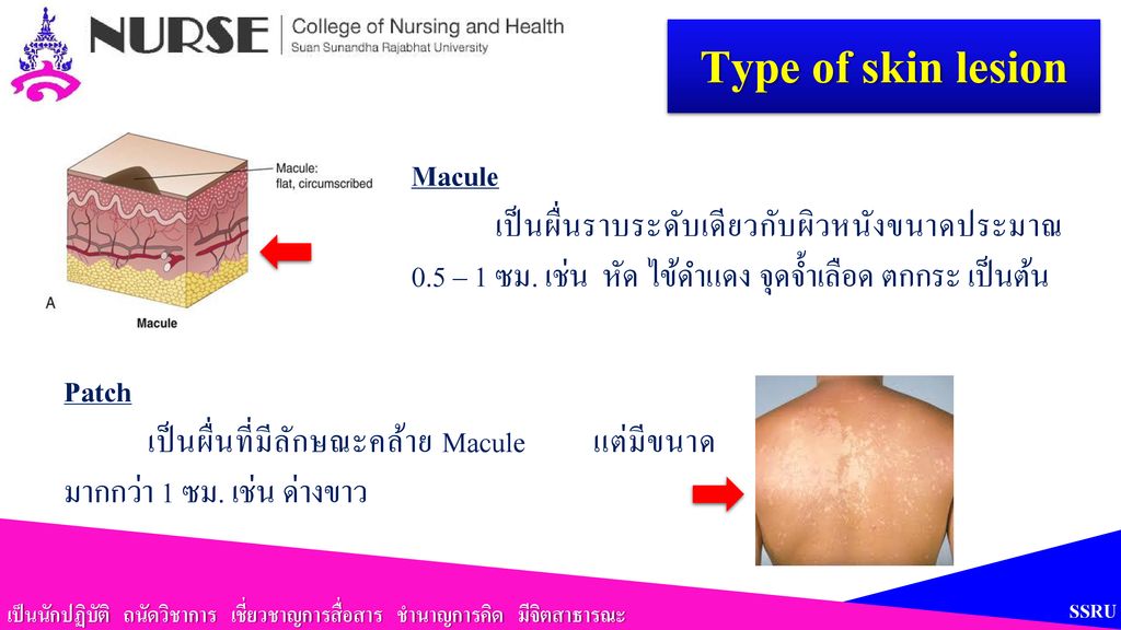 Type of skin lesion Macule
