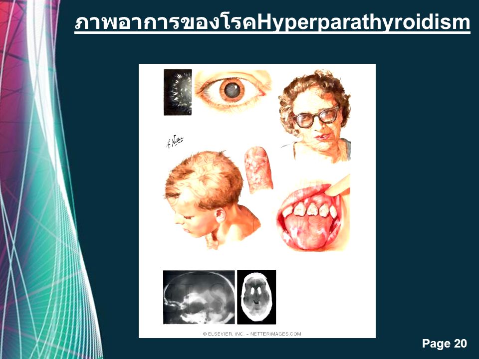 ภาพอาการของโรคHyperparathyroidism