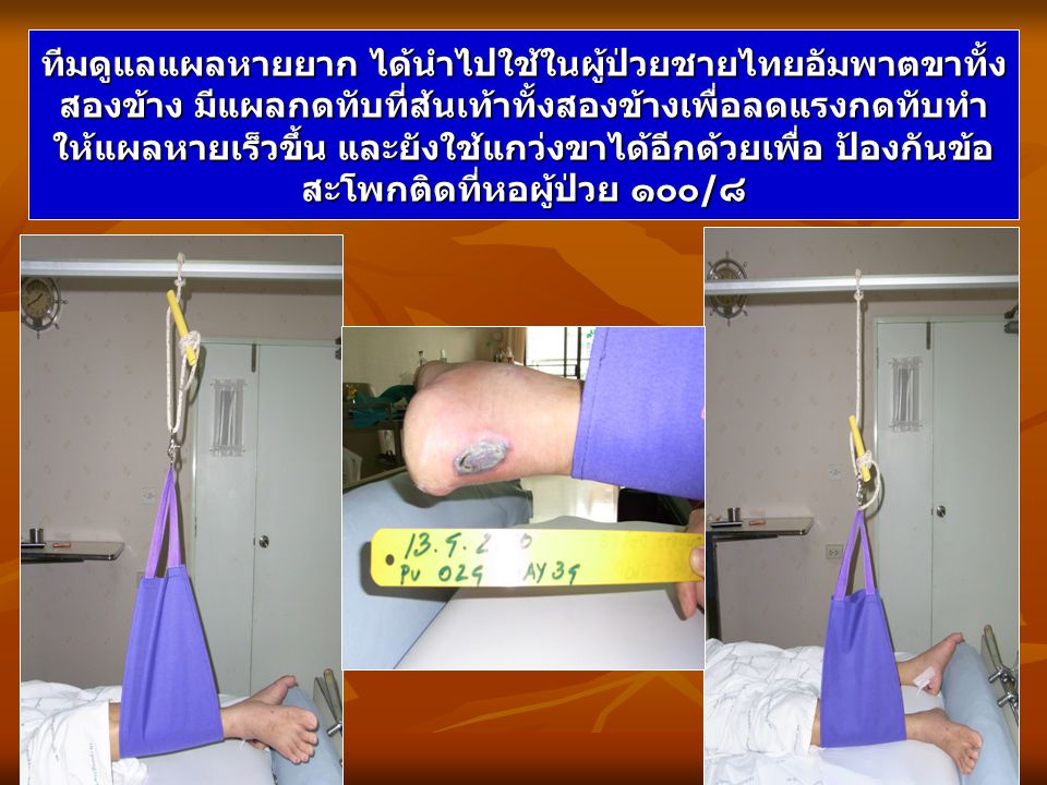 ทีมดูแลแผลหายยาก ได้นำไปใช้ในผู้ป่วยชายไทยอัมพาตขาทั้งสองข้าง มีแผลกดทับที่ส้นเท้าทั้งสองข้างเพื่อลดแรงกดทับทำให้แผลหายเร็วขึ้น และยังใช้แกว่งขาได้อีกด้วยเพื่อ ป้องกันข้อ สะโพกติดที่หอผู้ป่วย ๑๐๐/๘