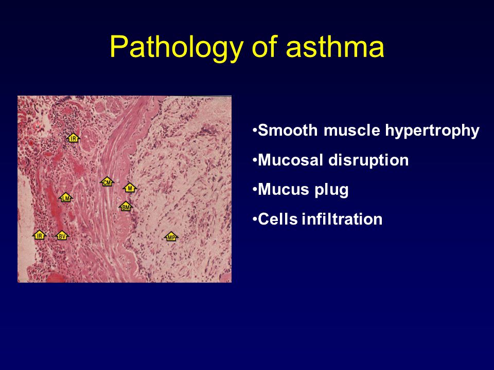 Pathology of asthma Smooth muscle hypertrophy Mucosal disruption