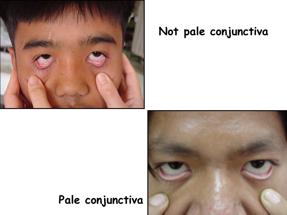 Not pale conjunctiva Pale conjunctiva