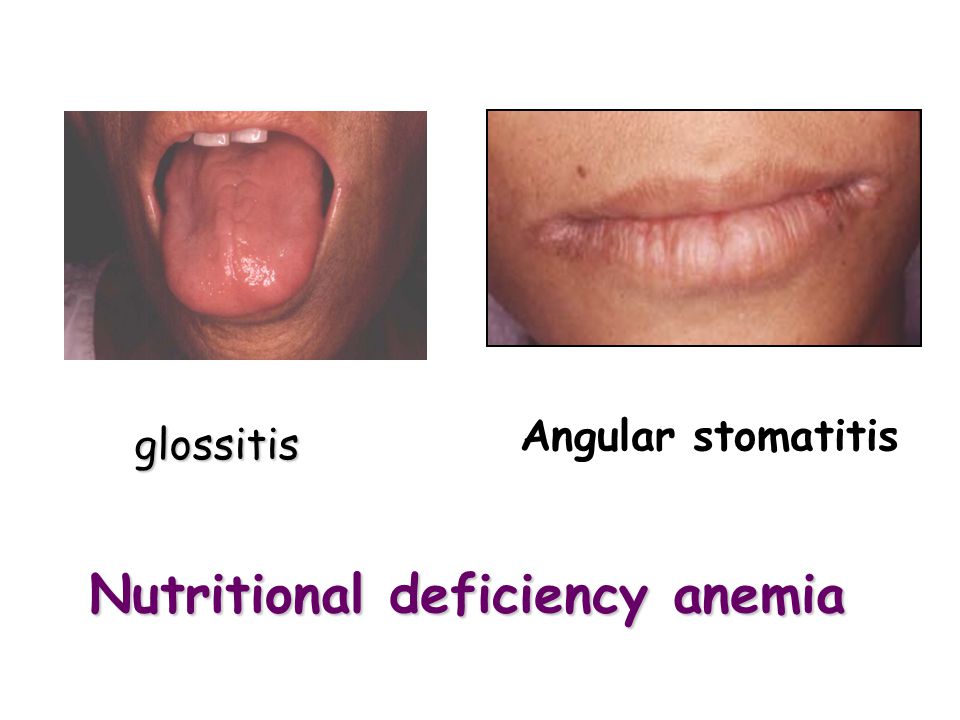 Nutritional deficiency anemia