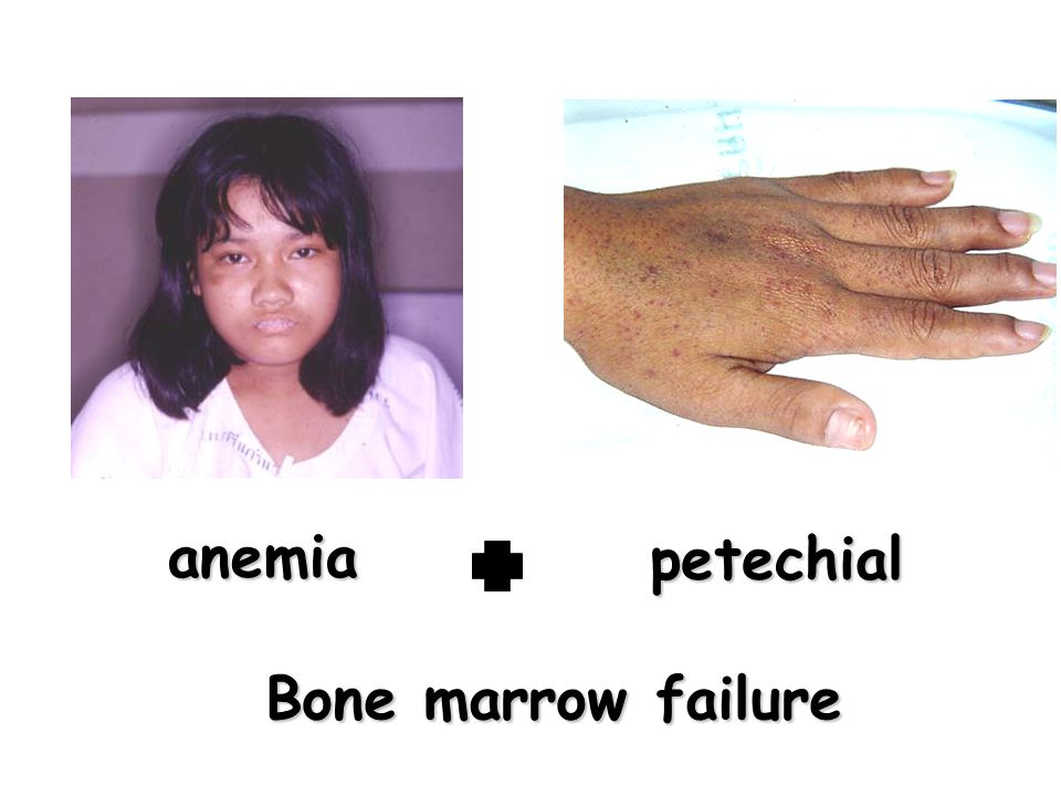 anemia petechial Bone marrow failure