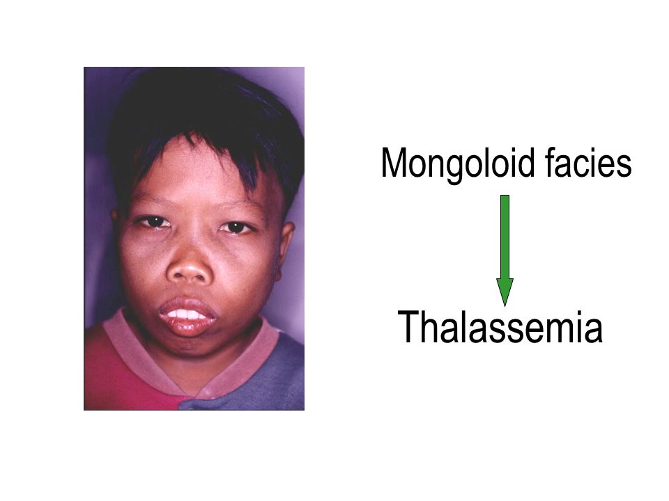 Mongoloid facies Thalassemia