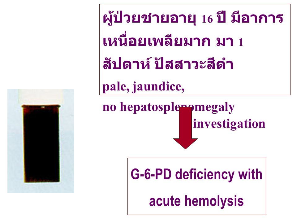 G-6-PD deficiency with acute hemolysis