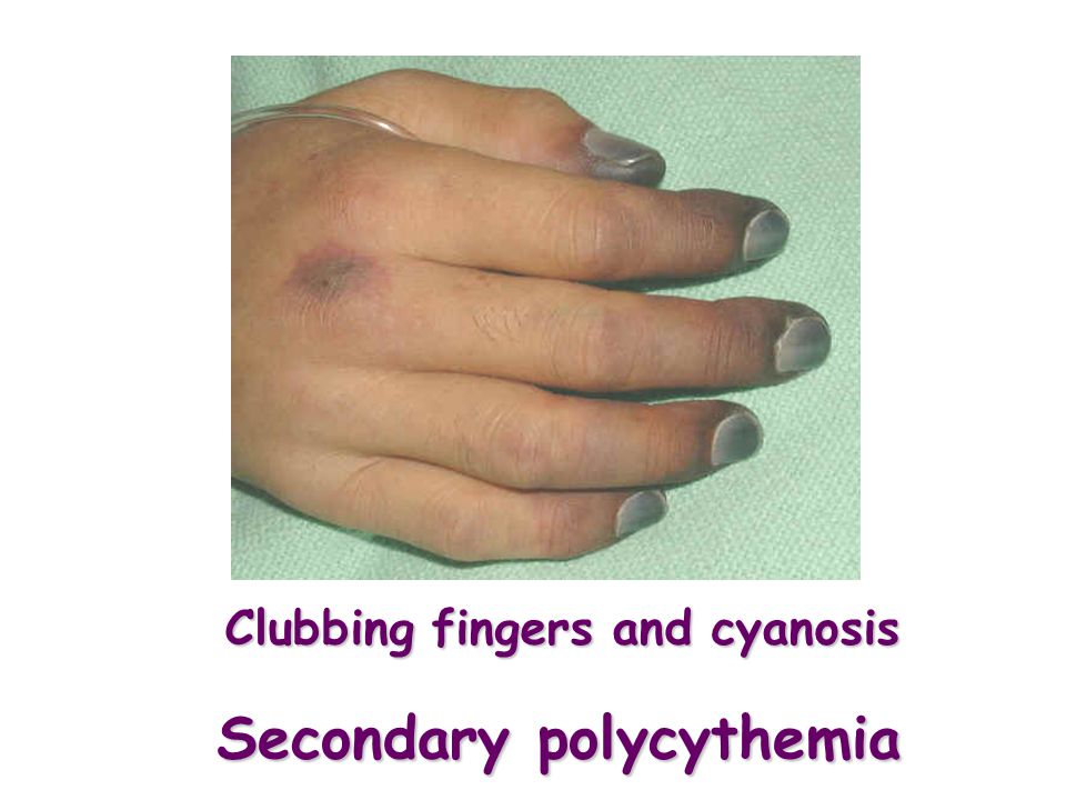 Secondary polycythemia