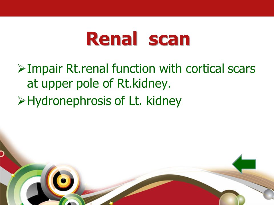 Renal scan Impair Rt.renal function with cortical scars at upper pole of Rt.kidney.
