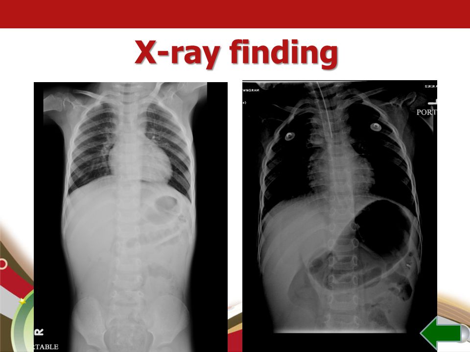 X-ray finding