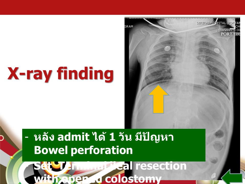 X-ray finding หลัง admit ได้ 1 วัน มีปัญหา Bowel perforation