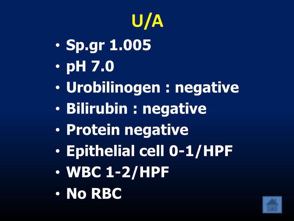 U/A Sp.gr pH 7.0 Urobilinogen : negative Bilirubin : negative