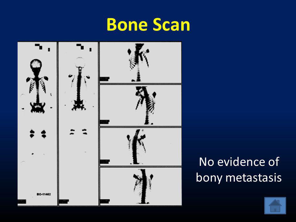 No evidence of bony metastasis