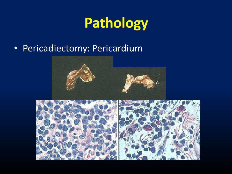 Pathology Pericadiectomy: Pericardium
