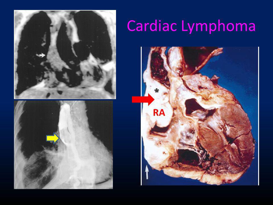 Cardiac Lymphoma RA