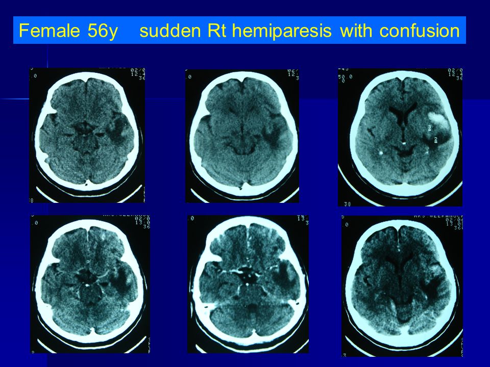 Female 56y sudden Rt hemiparesis with confusion