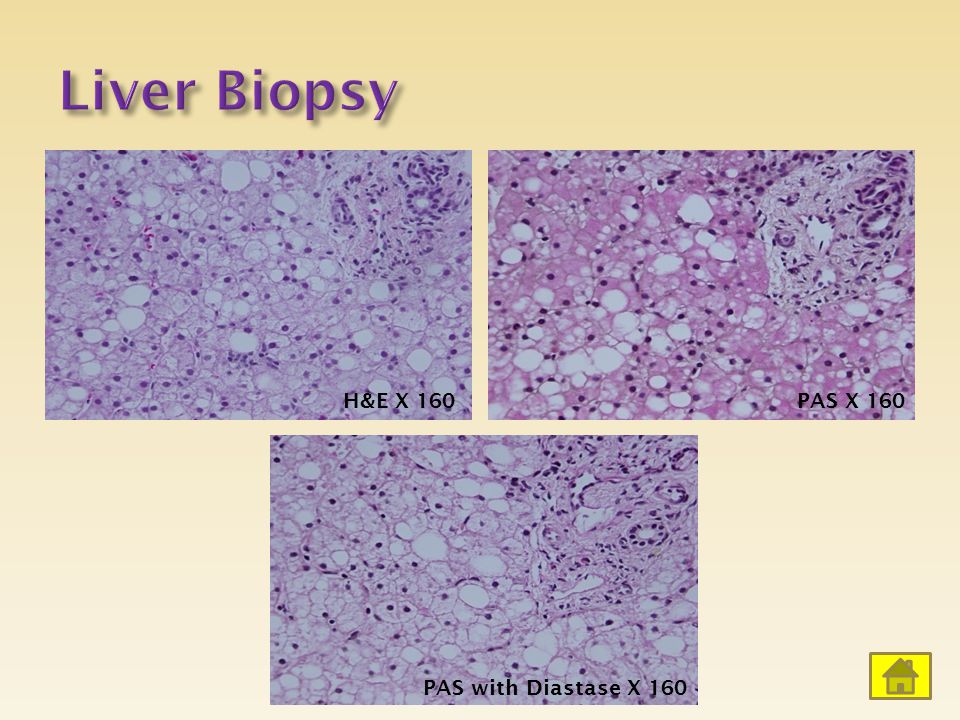 Liver Biopsy H&E X 160 PAS X 160 PAS with Diastase X 160
