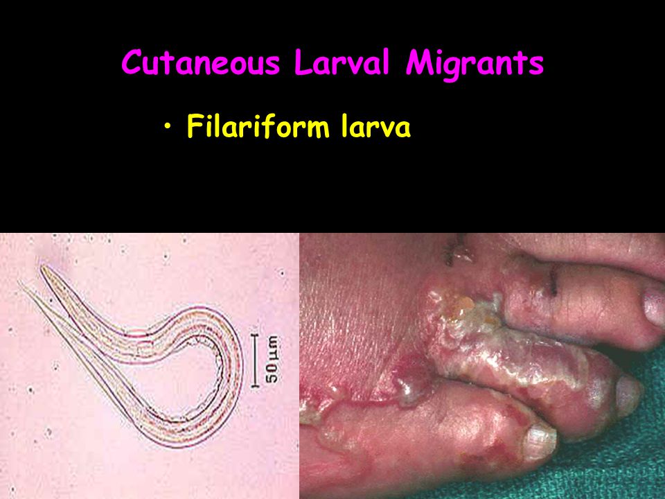 Cutaneous Larval Migrants