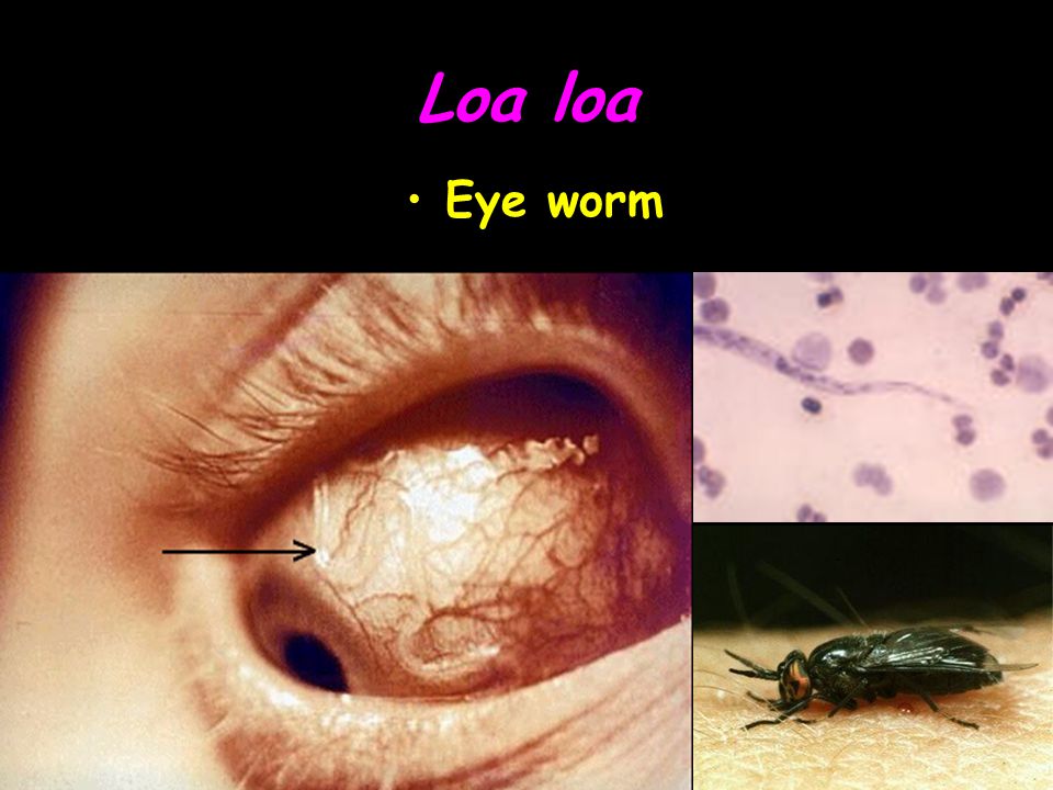 Loa loa Eye worm