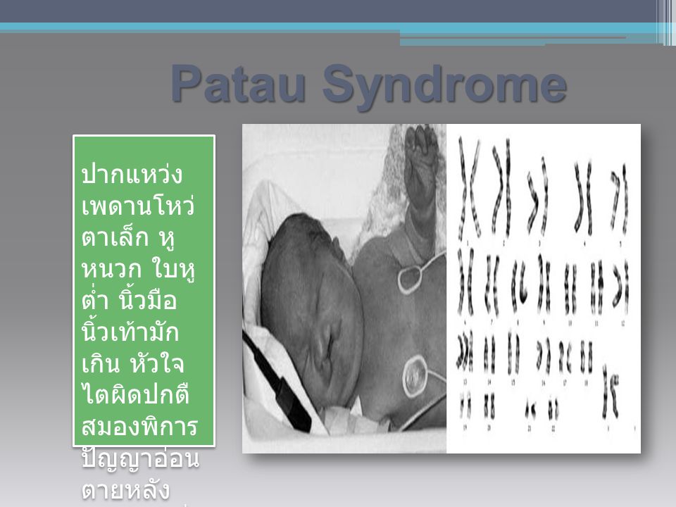 Patau Syndrome ปากแหว่ง เพดานโหว่ ตาเล็ก หู หนวก ใบ หูต่ำ นิ้ว มือนิ้วเท้า มักเกิน หัวใจ ไต ผิดปกตื สมองพิการ ปัญญาอ่อน ตายหลัง คลอดไม่กี่ เดือน.