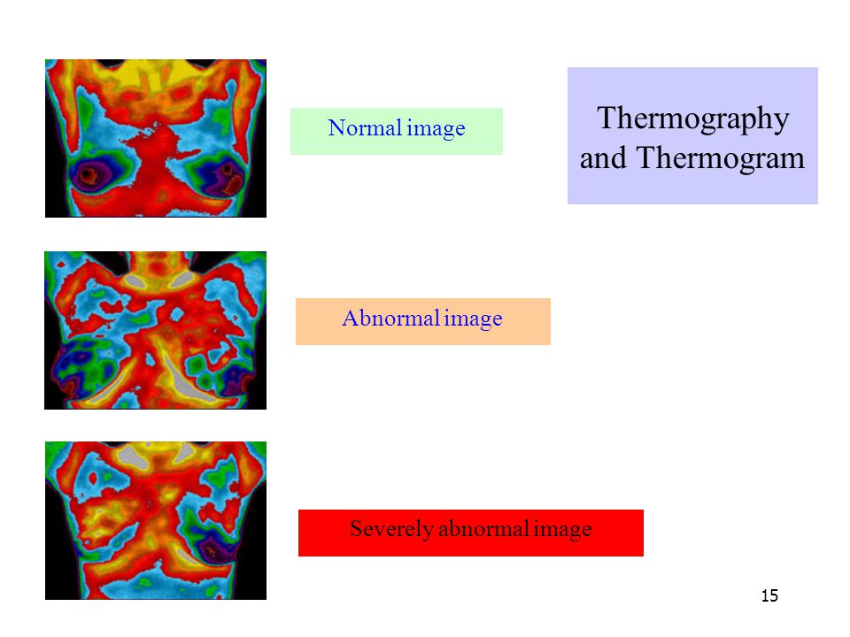 Thermography and Thermogram