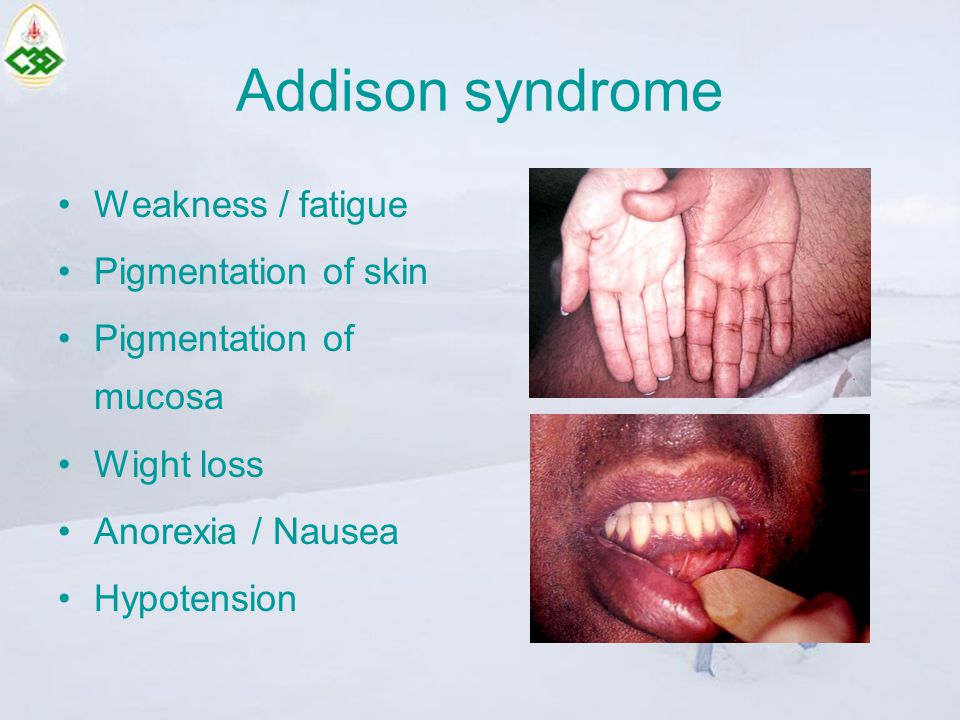 Addison syndrome Weakness / fatigue Pigmentation of skin