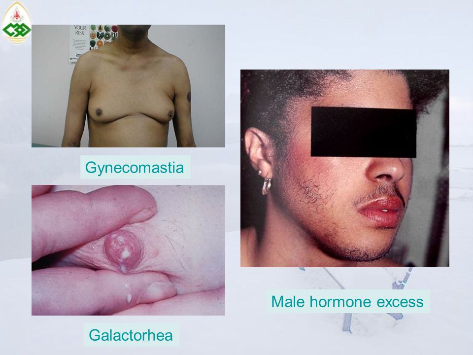 Gynecomastia Male hormone excess Galactorhea