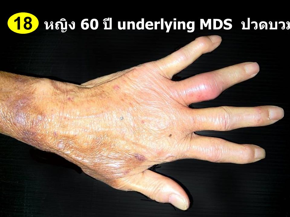 18 หญิง 60 ปี underlying MDS ปวดบวมข้อนิ้วมือ 1 สัปดาห์