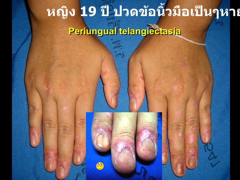 หญิง 19 ปี ปวดข้อนิ้วมือเป็นๆหายๆ 1 ปี