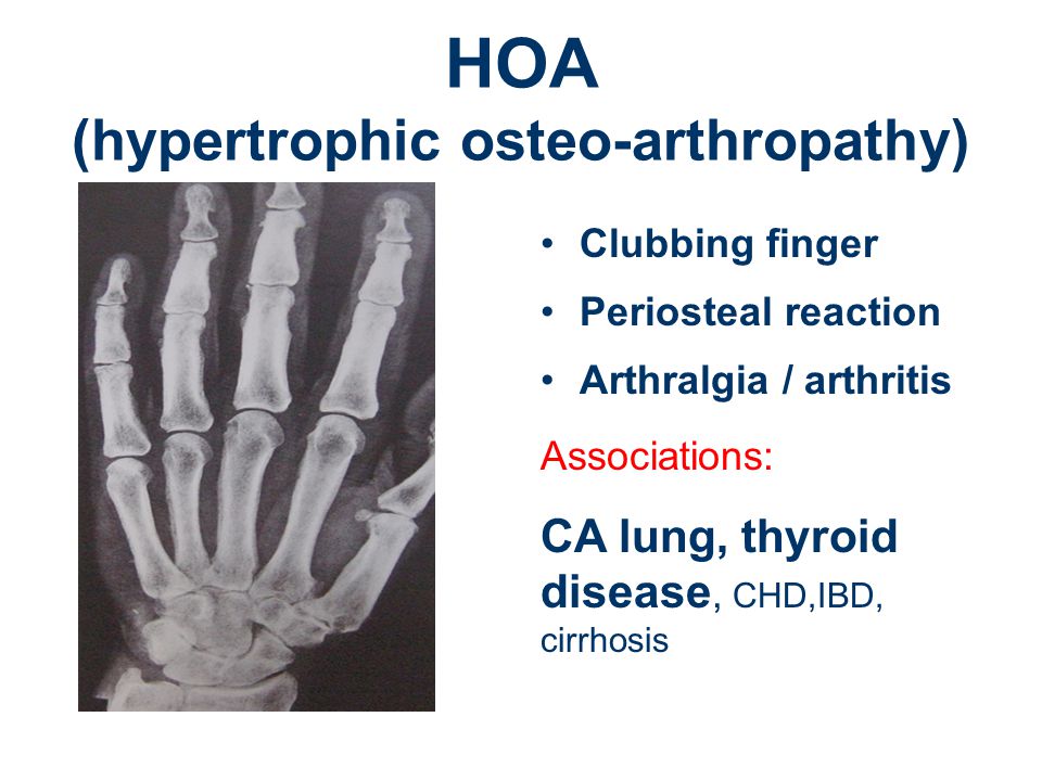 HOA (hypertrophic osteo-arthropathy)