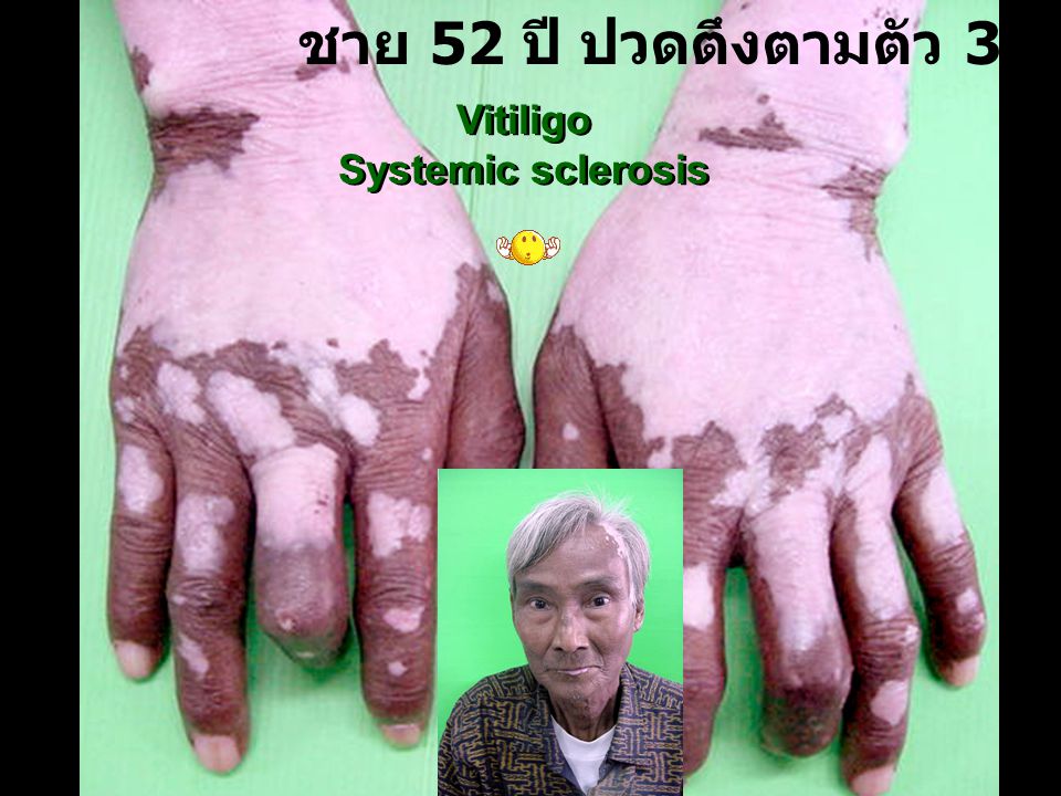 ชาย 52 ปี ปวดตึงตามตัว 3 ปี Vitiligo Systemic sclerosis