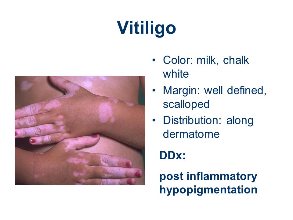 Vitiligo Color: milk, chalk white Margin: well defined, scalloped