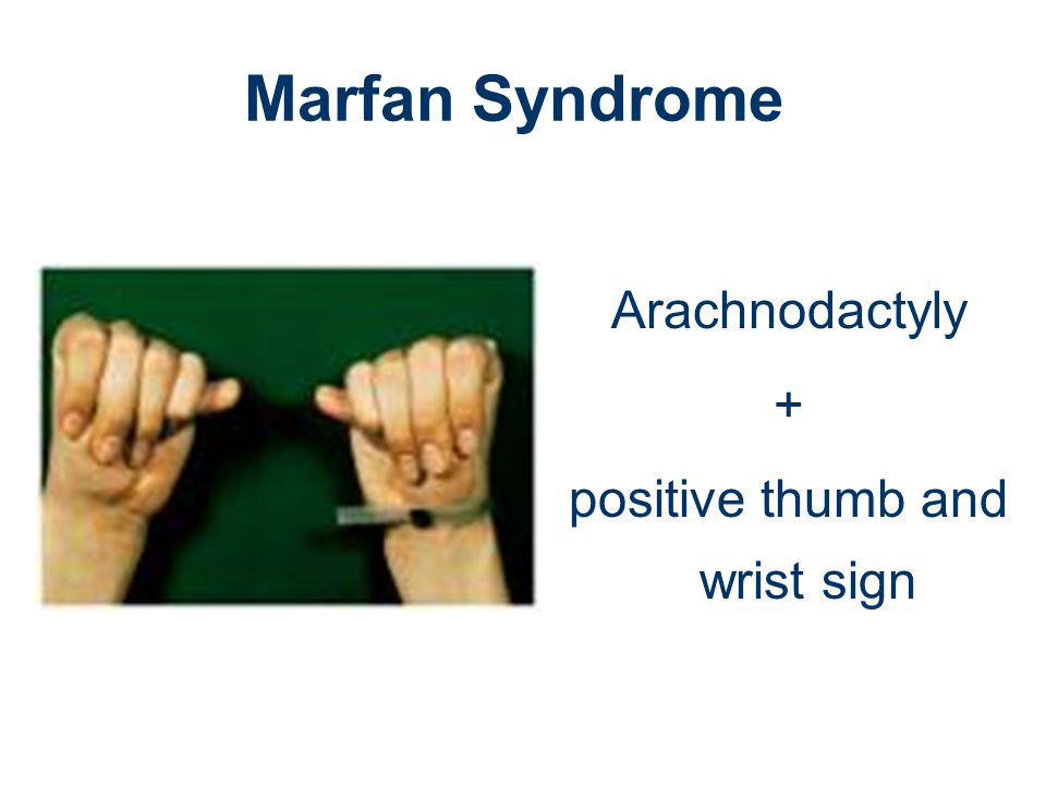 positive thumb and wrist sign
