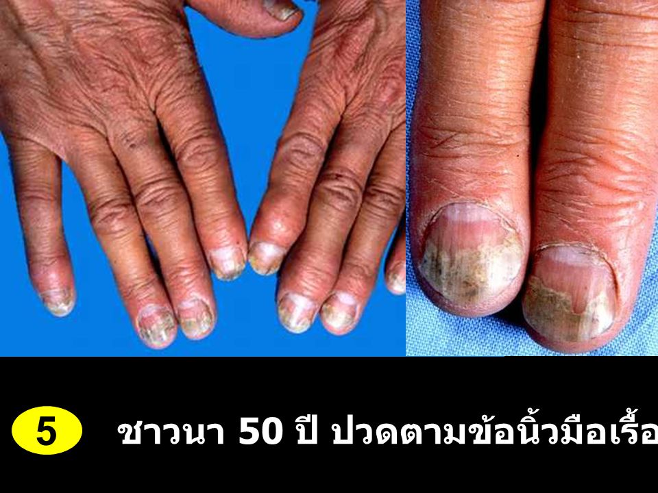 5 ชาวนา 50 ปี ปวดตามข้อนิ้วมือเรื้อรัง 3 ปี