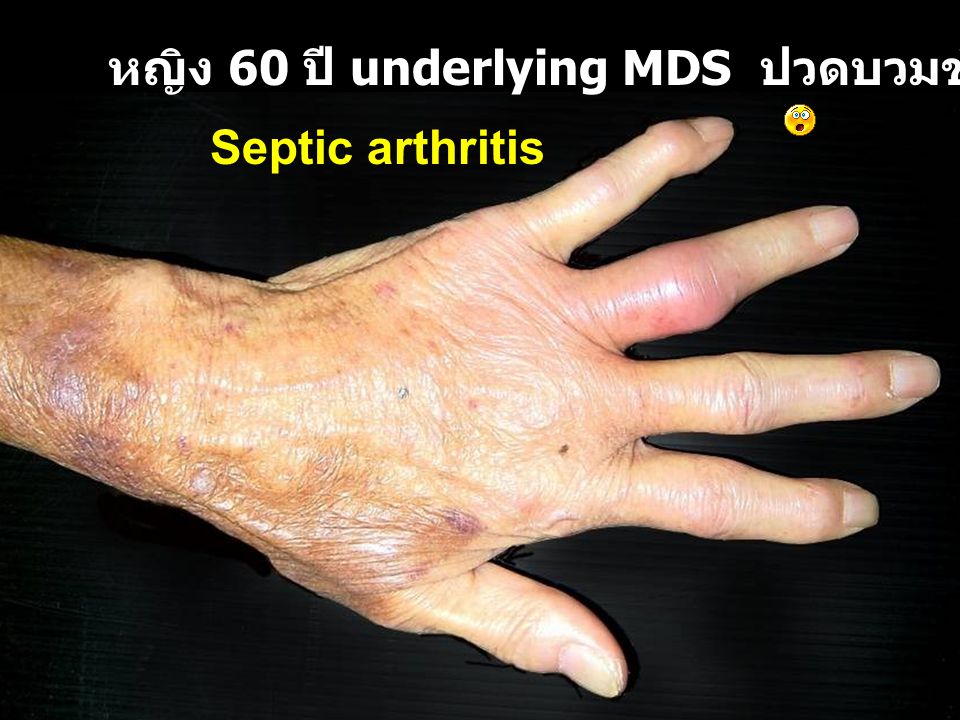 หญิง 60 ปี underlying MDS ปวดบวมข้อนิ้วมือ 1 สัปดาห์