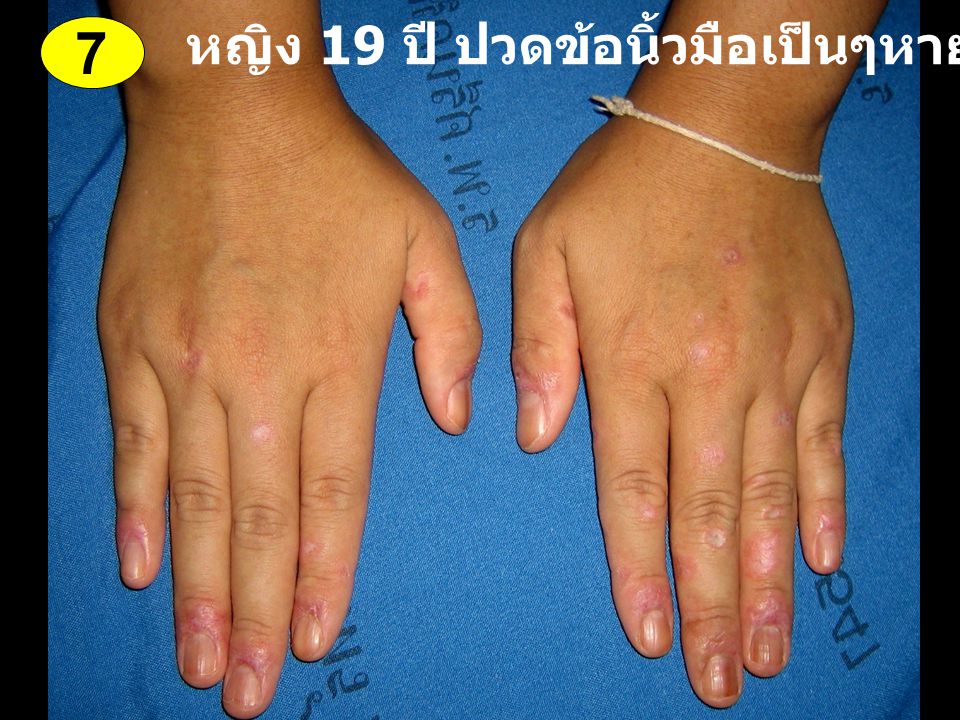 หญิง 19 ปี ปวดข้อนิ้วมือเป็นๆหายๆ 1 ปี