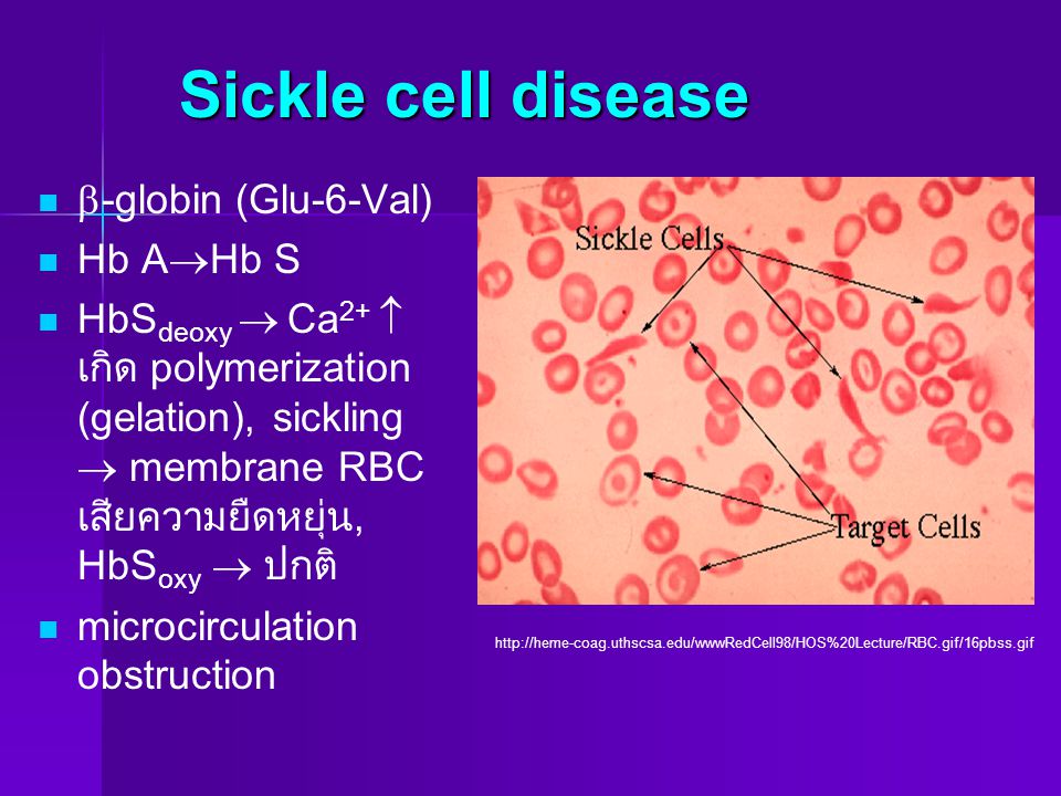Sickle cell disease -globin (Glu-6-Val) Hb AHb S
